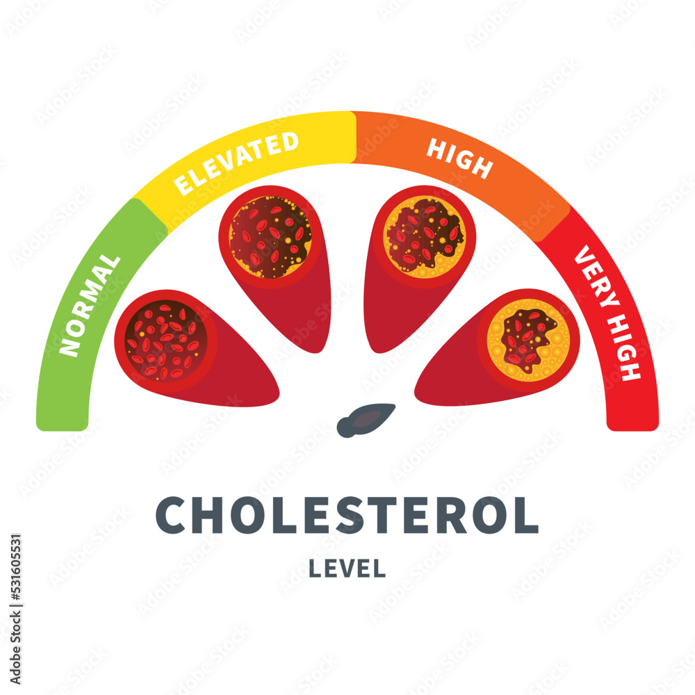 Different stages of cholesterol plaque buildup in artery. Low to high