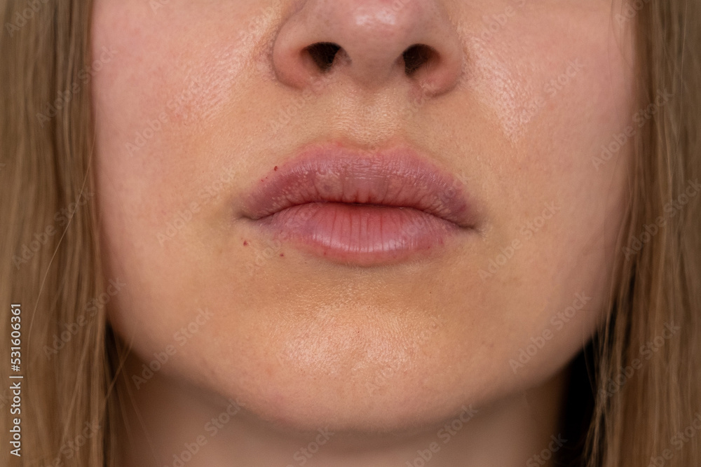 visible place of needle injection marks, woman lips push up close up view after lip augmentation procedure with fillers, increase lips hyaluronic acid, swelling after cosmetic procedure, cosmetician visible place of needle injection marks, woman lips push up close up view after lip augmentation procedure with fillers, increase lips hyaluronic acid, swelling after cosmetic procedure, cosmetician