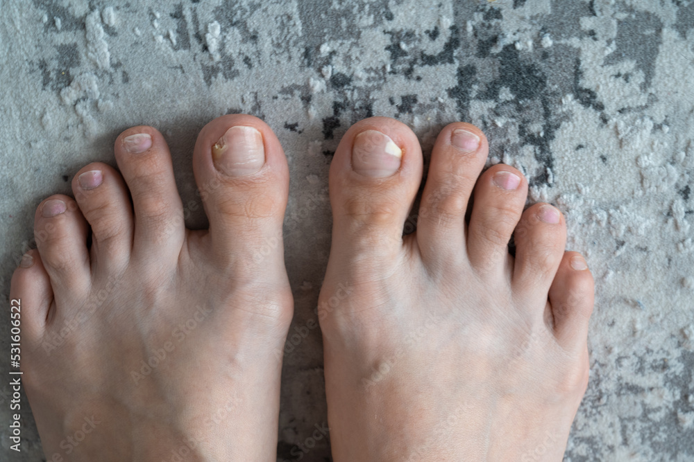 Foto de person feet close up, fungus, broken nail, skin infection, toe