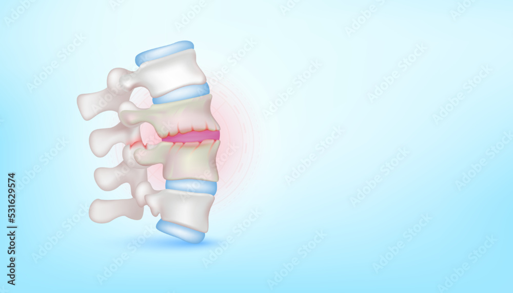 Backbone disc joint degeneration herniation cartilage on blue ...