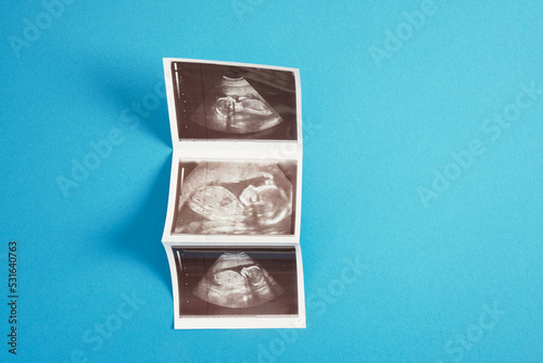 Ultrasound picture pregnant baby photo on blue background