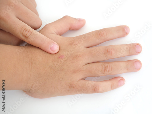 Scar on a kid hand, pointing at the scar. Closeup photo, blurred.
