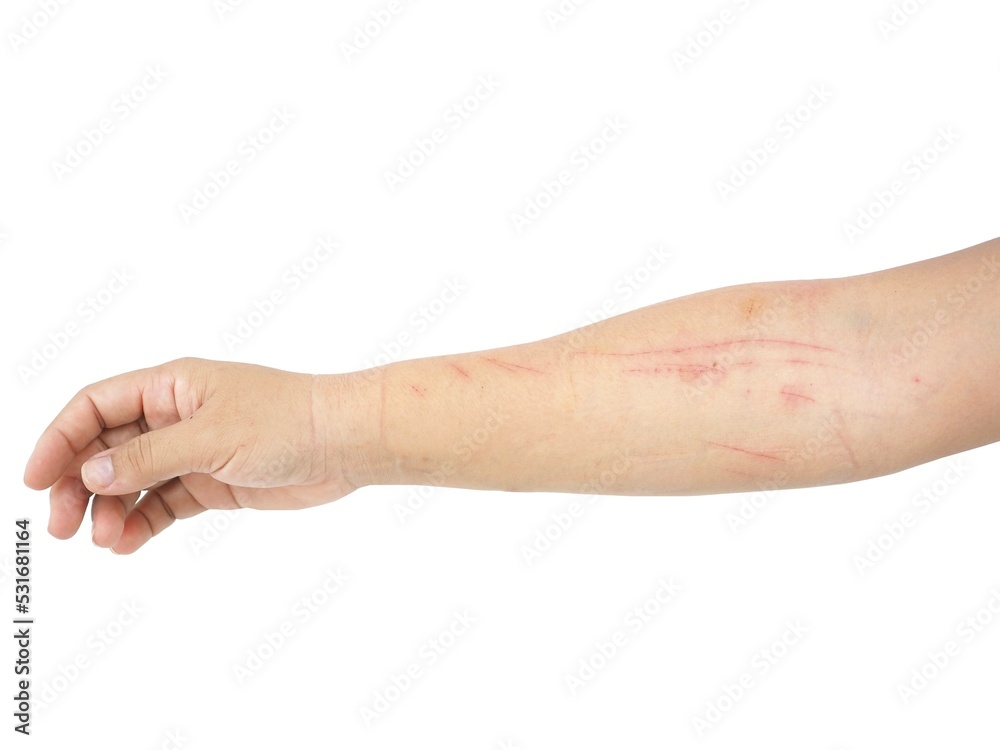 Scar on arm woman by cat pawing. Closeup photo, blurred. Scar on arm woman by cat pawing. Closeup photo, blurred.