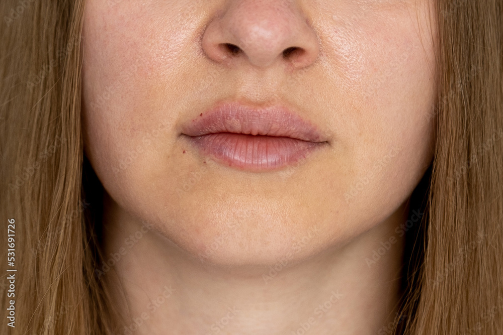 woman lips push up close up view after lip augmentation procedure with fillers, increase lips hyaluronic acid, visible place of needle injection marks, swelling after cosmetic procedure, cosmetician woman lips push up close up view after lip augmentation procedure with fillers, increase lips hyaluronic acid, visible place of needle injection marks, swelling after cosmetic procedure, cosmetician