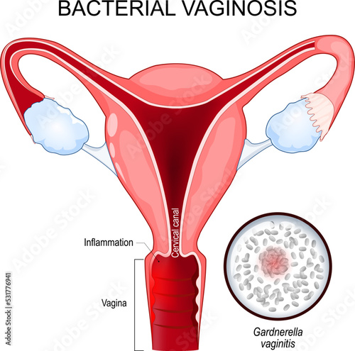 Bacterial vaginosis photo