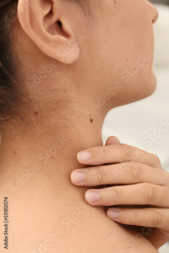 Closeup view of woman`s body with birthmarks