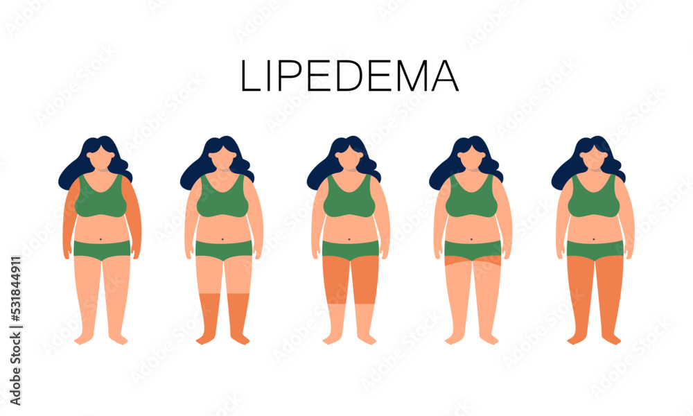 Vettoriale Stock Lipedema Disease Concept Accumulating Fat In The Lover Part Of The Female Body