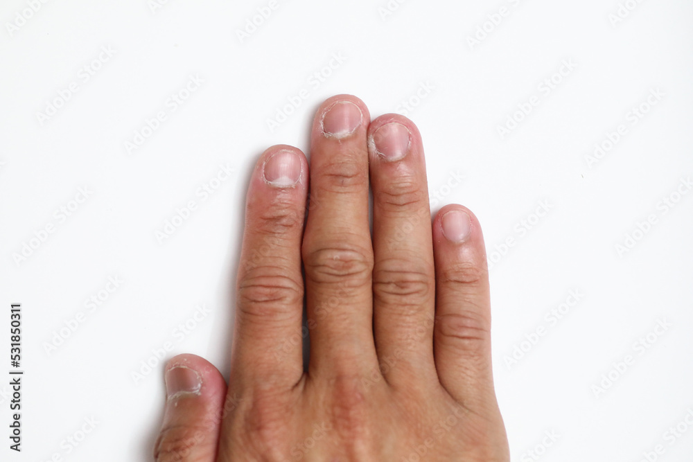 Dry skin crack on all fingernail with isolated background, xeroderma Dry skin crack on all fingernail with isolated background, xeroderma