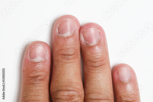 Dry skin crack on all fingernail with isolated background, xeroderma