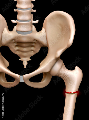 Fractured femur, illustration photo