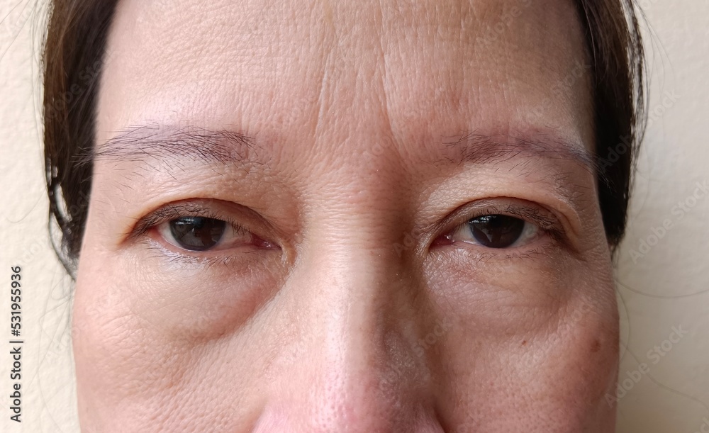 Fototapeta premium Bags under the eyes of a woman have swelling.