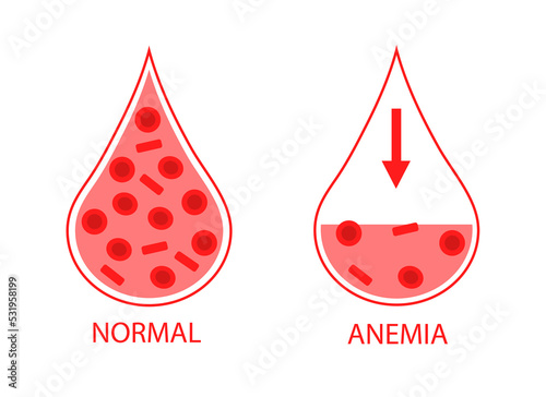 Comparing two drops of blood normal and anemic blood cells. Low hemoglobin. Isolated image on white background.