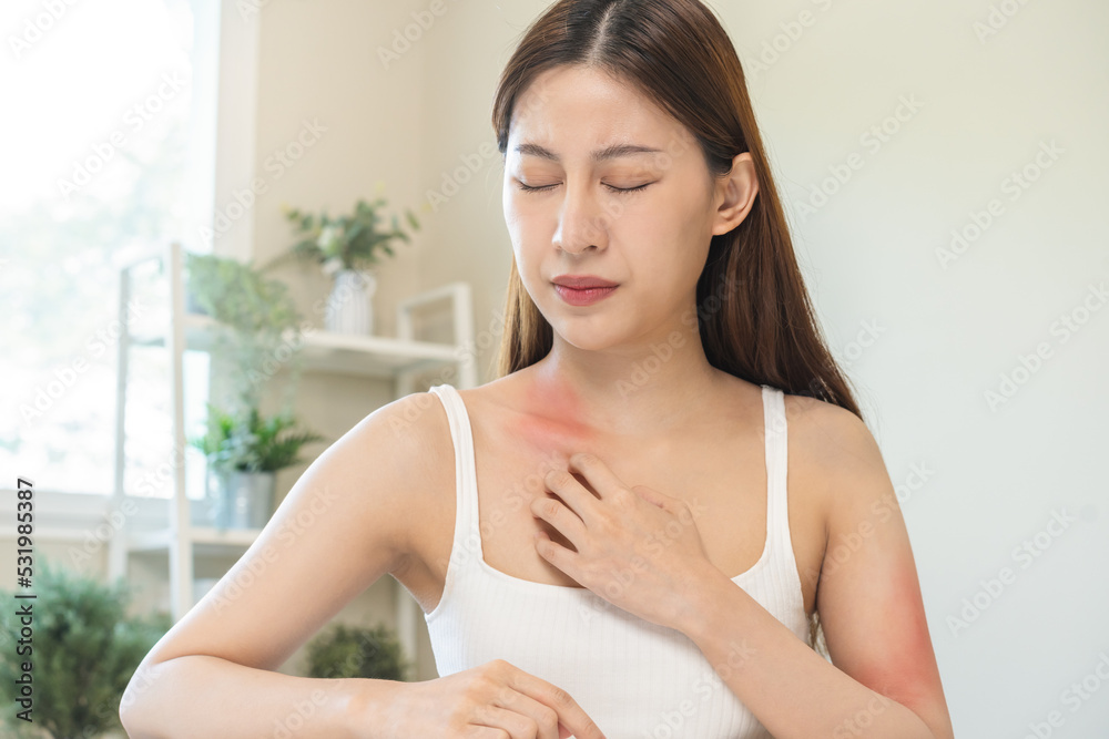 Dermatology, asian young woman, girl allergy, allergic reaction from atopic, insect bites on her body, hand in scratching itchy, itch red spot or rash of skin. Healthcare, treatment of beauty. Dermatology, asian young woman, girl allergy, allergic reaction from atopic, insect bites on her body, hand in scratching itchy, itch red spot or rash of skin. Healthcare, treatment of beauty.