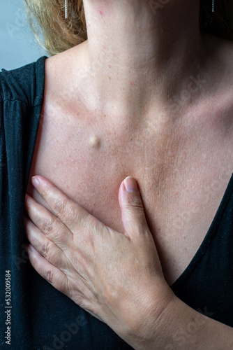 A sebaceous cyst or fatty lump on the skin of a mature woman on the chest area 