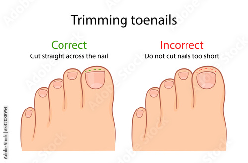 correct and improper cutting of the toenail. medical illustration