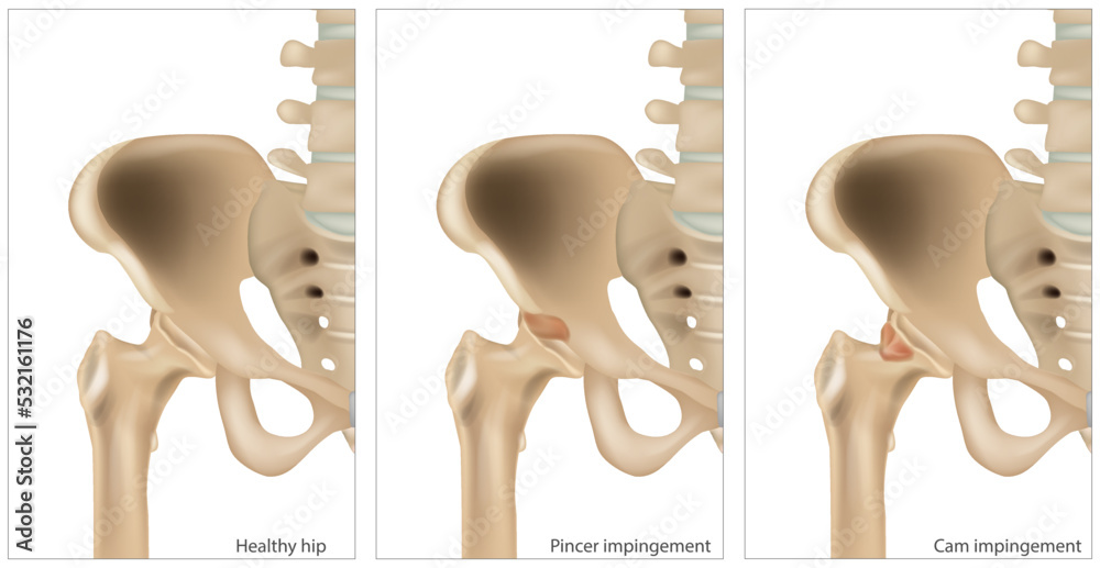 Medical illustration of the Femoroacetabular Impingement. Different of the Cam impingement and
