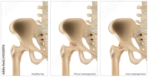 Medical illustration of the Femoroacetabular Impingement. Different of the Cam impingement and Pincer impingement. Healthy hip photo