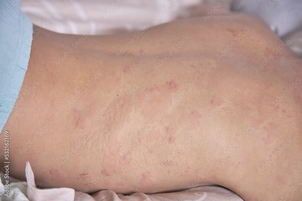 Itchy skin, dermatitis, food allergies. Baby showing her back with acne