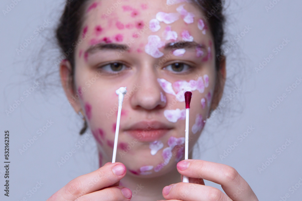 The skin rash in a child is treated with a cotton swab. Chickenpox