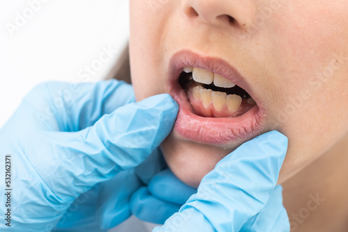 Cropped view of the little girl having her plates checked. Close-up portrait of smiling teenage girl with teeth plates against dentist sitting in clinic. Girl with plates being examined by dentist