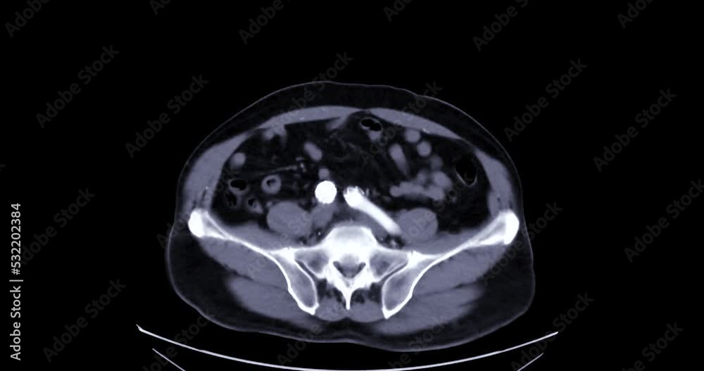 CTA abdominal aorta for Evaluation of the abdominal and thoracic aorta after stent replacment in case abdominal aortic aneurysm. CTA abdominal aorta for Evaluation of the abdominal and thoracic aorta after stent replacment in case abdominal aortic aneurysm.