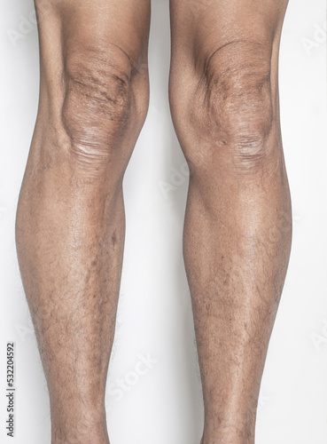 Leg and knee joints of the elderly with muscle and bone degeneration lesion, dermatitis, dark spots of the skin on the legs on a white backdrop.