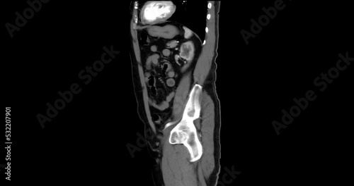 CTA abdominal aorta for Evaluation of the abdominal and thoracic aorta after stent replacment in case abdominal aortic aneurysm. photo