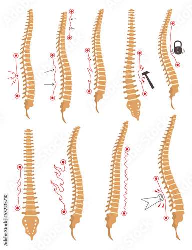 Spinal deformity types. Symbols of spine curvatures or unhealthy backbones. Human spine anatomy, curved spine. Diagram with marked sections. Body posture defects