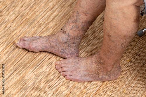 Unrecognizable senior woman bare legs with protruding varix, spider varicose veins medical condition. Checking health for thrombosis, thrombophlebitis. Problem of blood vessels, vascular medicine