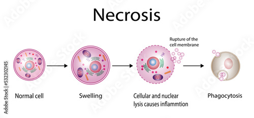 Necrosis, Pathologic Cell Death, Death of the body tissues, Cell injury which results in the premature death of cells in living tissue by autolysis. photo