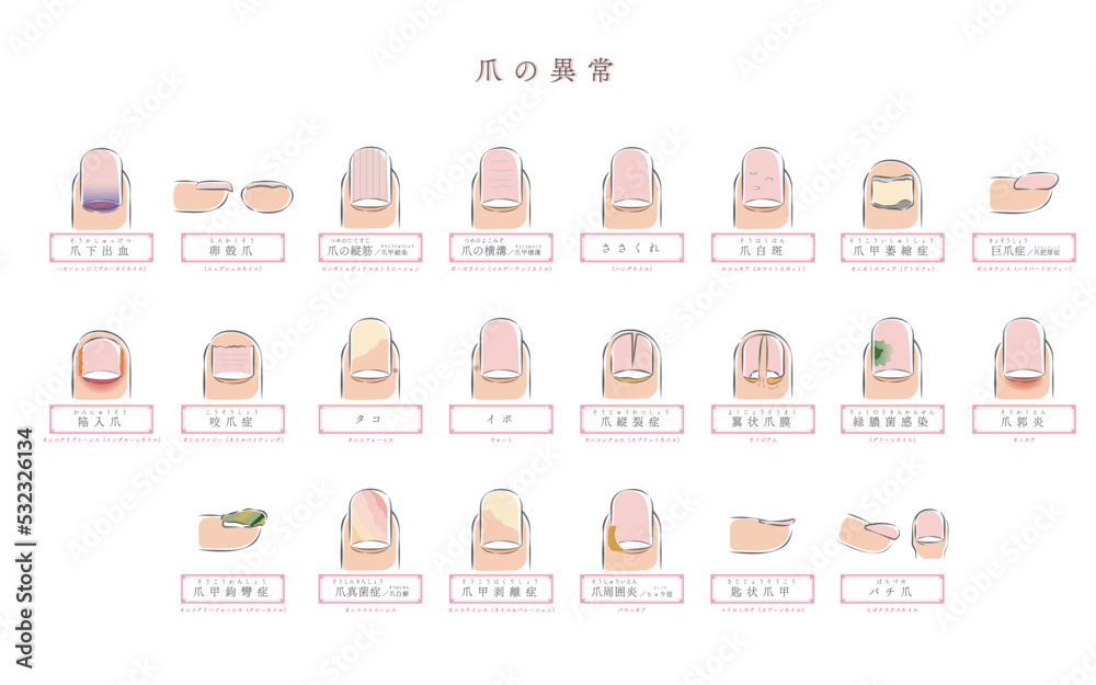 爪生え方の異常 – 爪 白癬 _ 爪の変形、異栄養症、変色 – ZPFQL