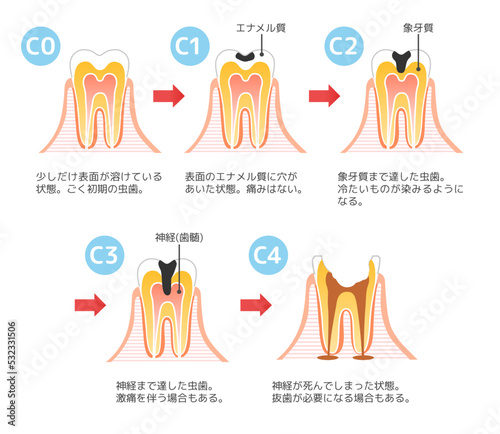 虫歯と進行C1~C4と治療:歯科のイラスト.