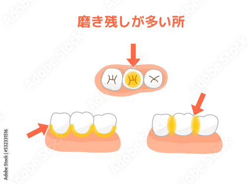 タフトブラシ歯磨き　食べ残し.