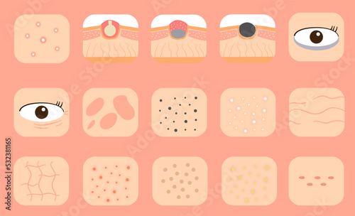 Skin problem illustration set. Vector of skin problem such as acnes, pimples, blackheads, whiteheads and others