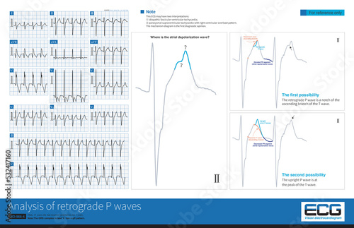 During an episode of tachycardia, retrograde P waves can overlap any part of the T wave, forming a T wave notch that is sometimes misdiagnosed as an upright P wave. photo