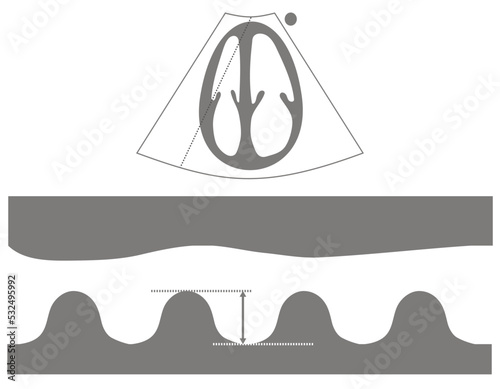 Diagram of Measurement of Tricuspid Annulus Plane Systolic Excursion or TAPSE From Echocardiogram