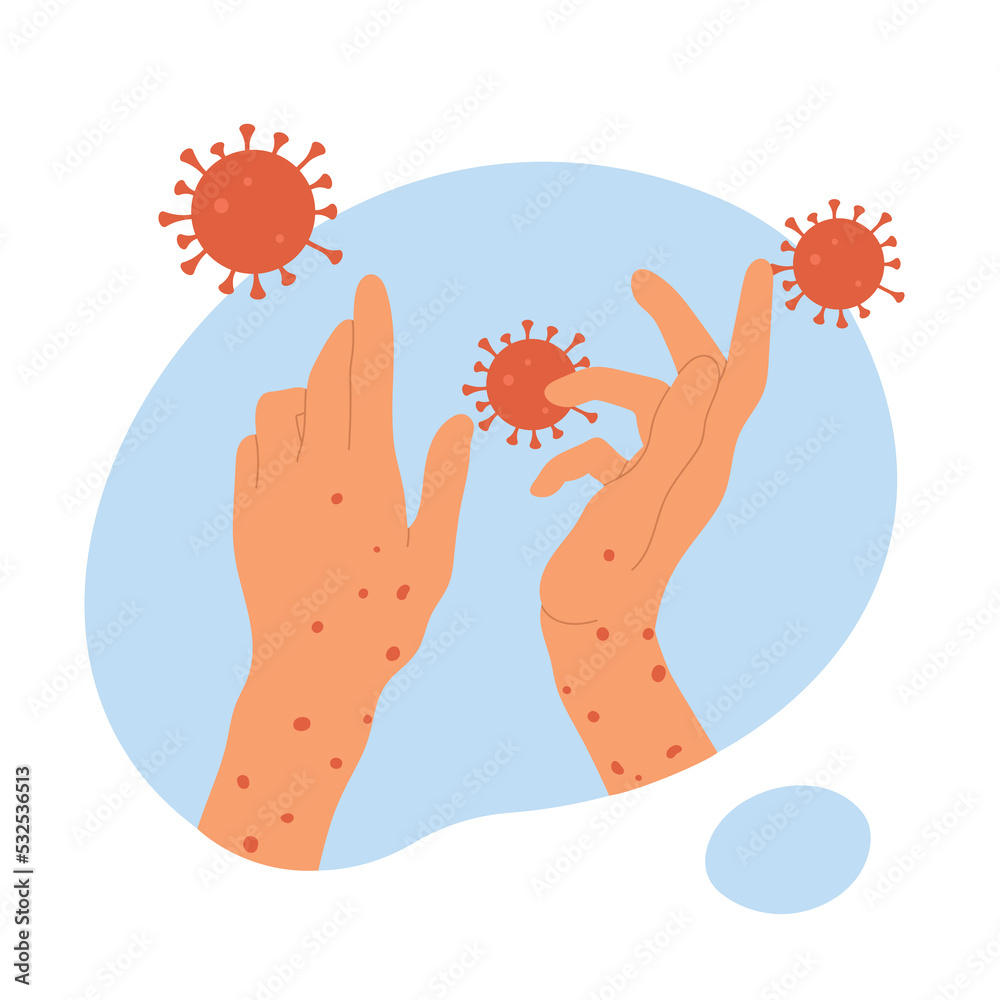 Monkeypox virus. Human hands with monkeypox. Skin infection concept. An outbreak of a smallpox pandemic. Vector illustration in cartoon style. Isolated on white background.	
 - obrazy, fototapety, plakaty 