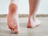 Close up photo of plantar wart on man's foot. Verruca plantaris on the heel.