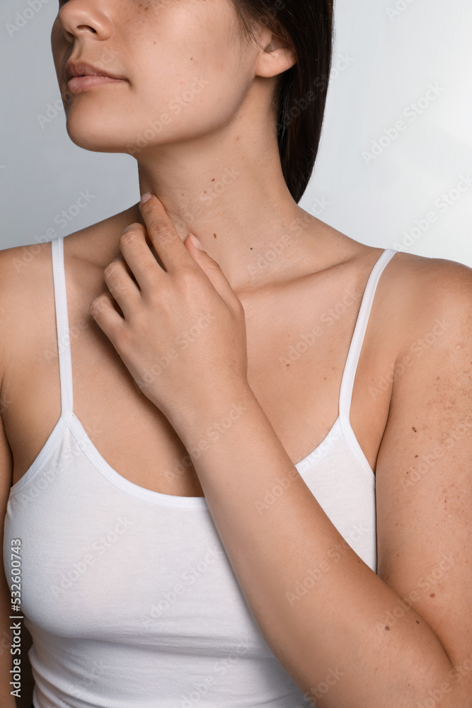 Closeup view of woman`s body with birthmarks on light grey background