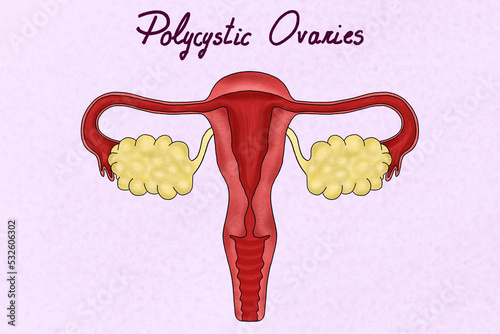 Female reproductive system illustration. Polycystic ovary syndrome photo