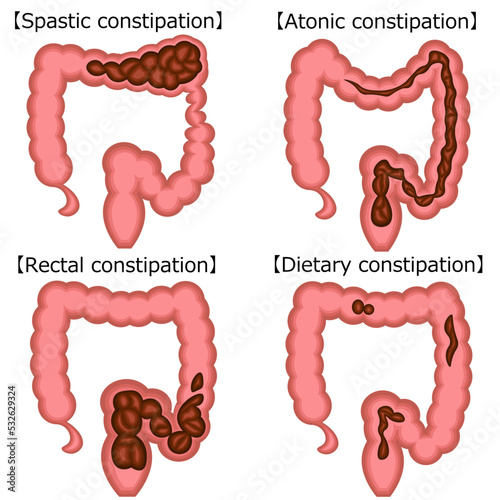 機能性の便秘　イラスト
