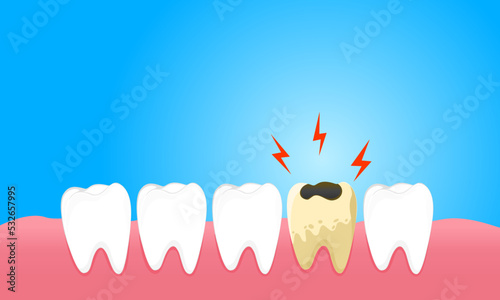 Cavities cause gum pain and tooth sensitivity.