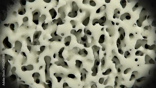 Osteoporosis weakening bone, animation photo