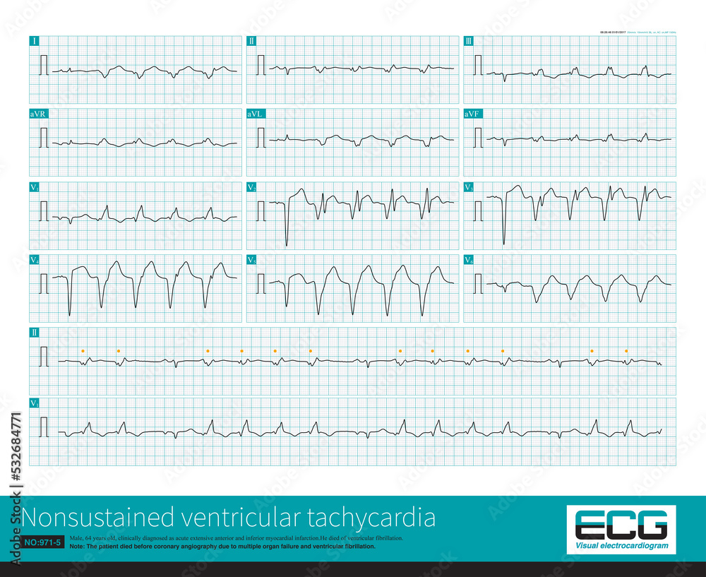 This case is a patient with acute extensive anterior MI. During hospitalization, short bursts of ventricular tachycardia occurred, and each episode lasted for 4 ventricular beats. This case is a patient with acute extensive anterior MI. During hospitalization, short bursts of ventricular tachycardia occurred, and each episode lasted for 4 ventricular beats.