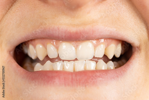 Patient with malocclusion, gap between upper and lower teeth, close-up mouth.