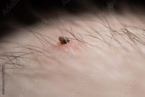 Sucking a tick Macro photo on human skin. Ixodes ricinus. The swollen parasite has bitten the irritated pink epidermis. Small red drops. Dangerous insect mite. Encephalitis, Lyme disease infection