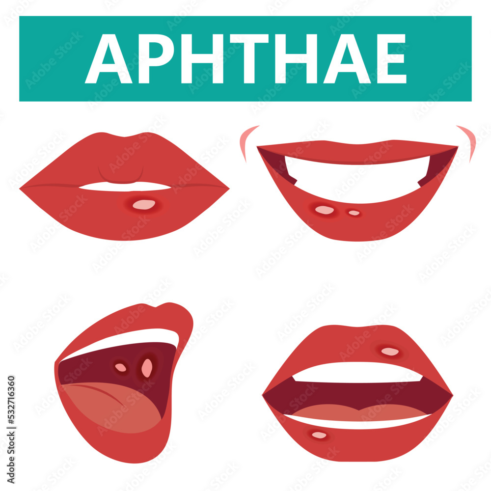 Aphthous ulcers on mouth close up,, vector illustration cartoon flat