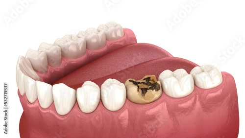 Caries removing, preparation, dental impression and crown placement. 3D animation