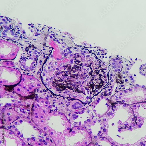 Camera photo of fibrinoid necrosis in the glomeruli, magnification 400x, silver stain, photograph through a microscope