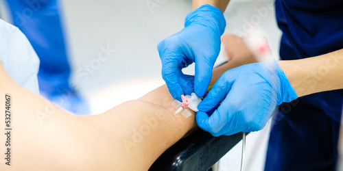 A doctor in sterile gloves inserts a catheter needle into the patient's arm. Installation of a catheter-butterfly in a person's arm for intravenous infusion of drugs.